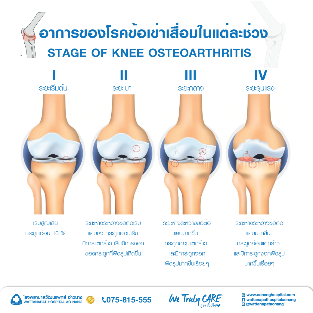 อาการของโรคข้อเข่าเสื่อมในแต่ละช่วง