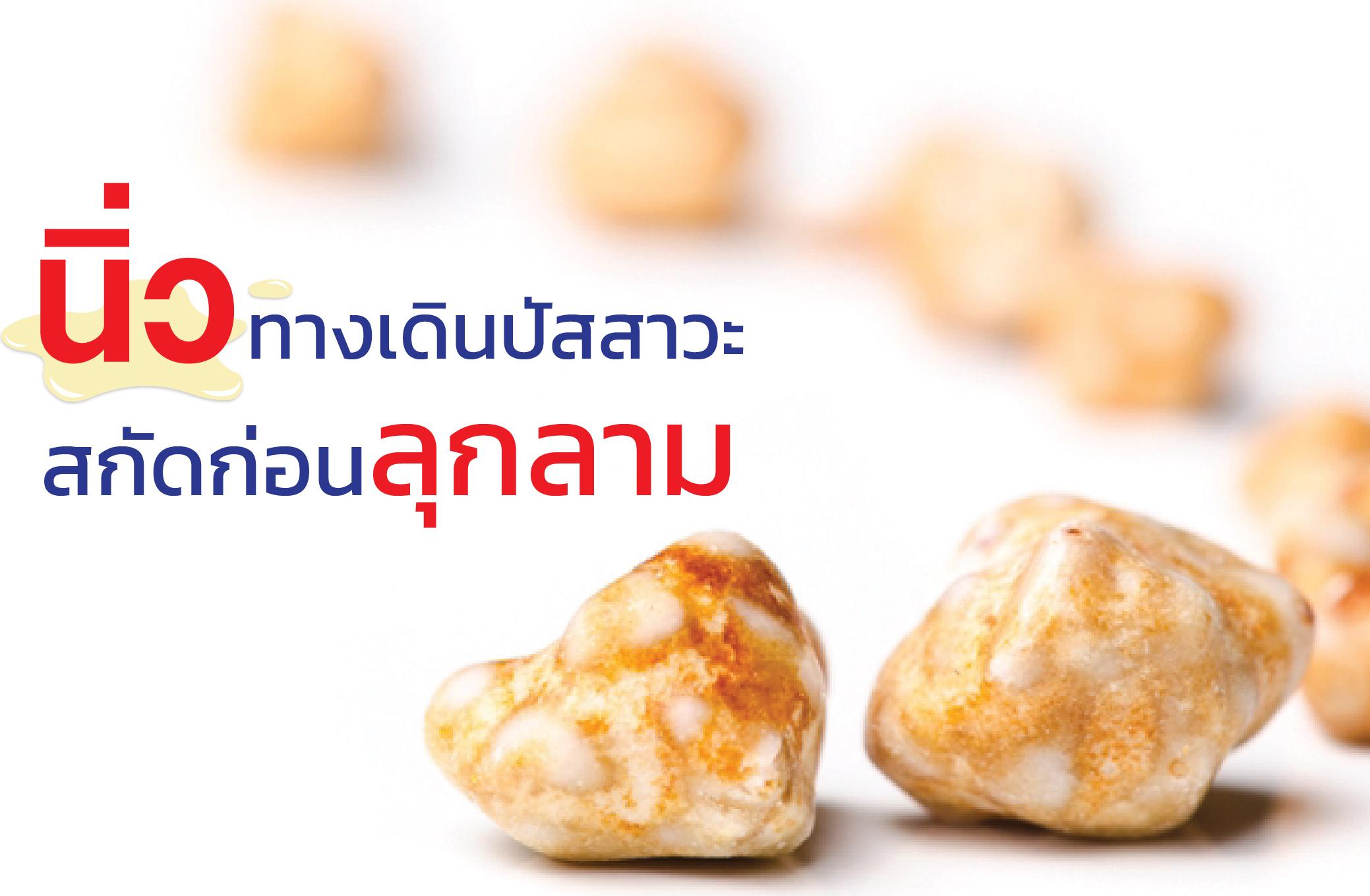 นิ่วทางเดินปัสสาวะสกัดก่อนลุกลาม