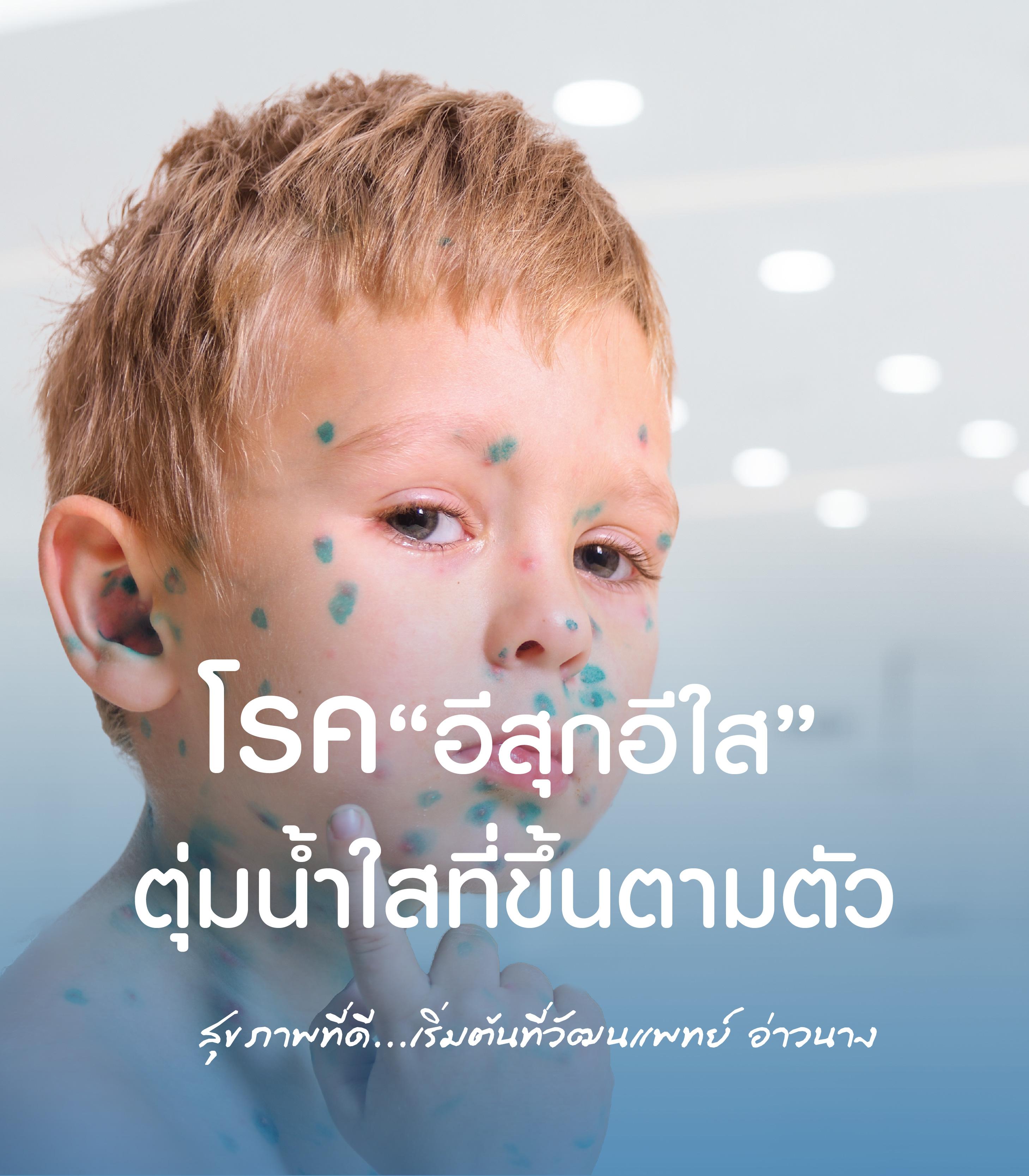 Chickenpox