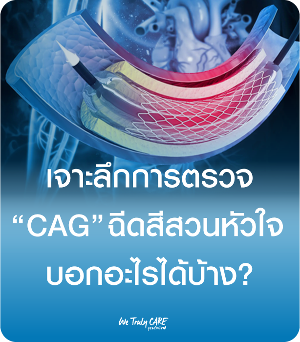 เจาะลึกการตรวจ CAG ฉีดสีสวนหัวใจ บอกอะไรได้บ้าง?