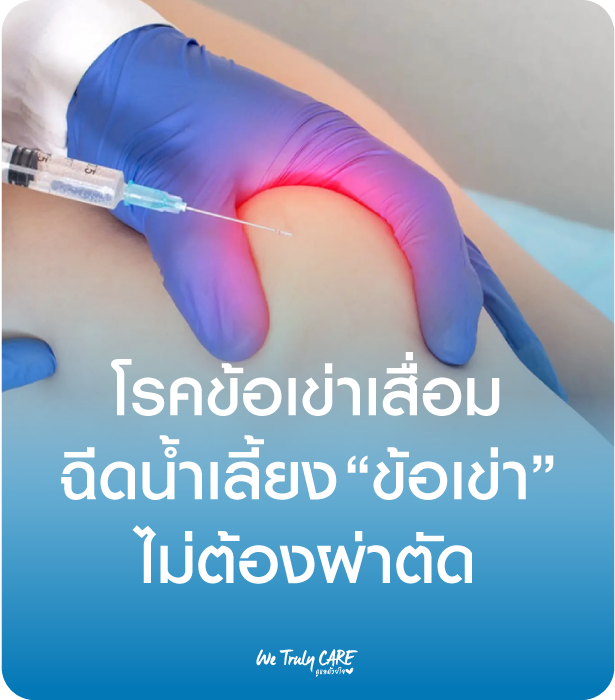 โรคข้อเข่าเสื่อม ฉีดน้ำเลี้ยงข้อเข่าช่วยได้ ไม่ต้องผ่าตัด