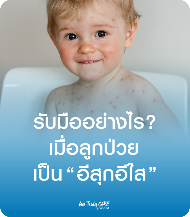 รับมืออย่างไร? เมื่อลูกป่วยเป็นโรคอีสุกอีใส